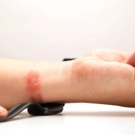 بند ساعت مناسب برای پوست حساس